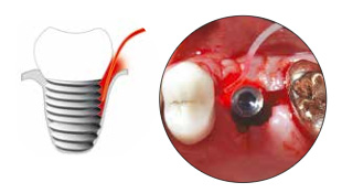 Pact-Therapie Periimplantitis